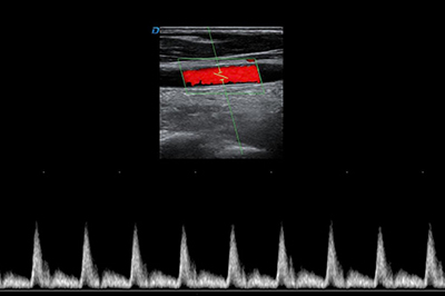 颈总动脉PW模式