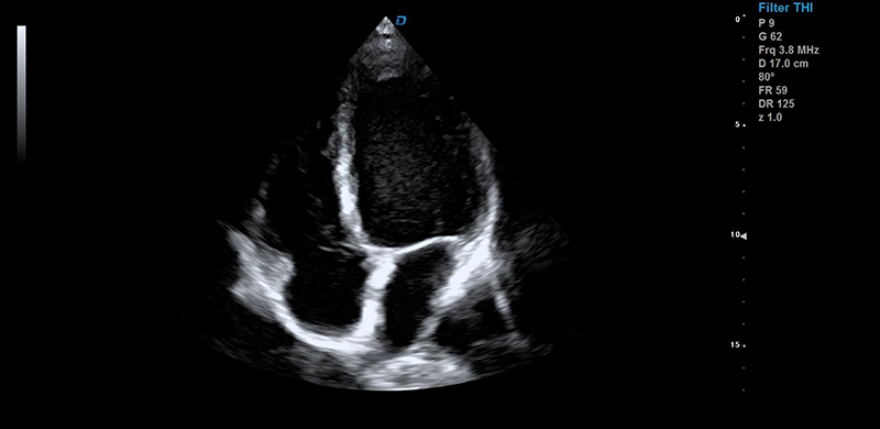 彩超机心脏检测图