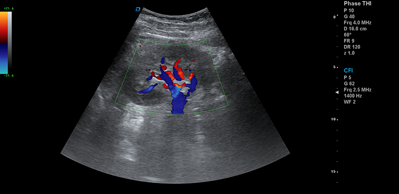 彩超机肾脏血流检测图