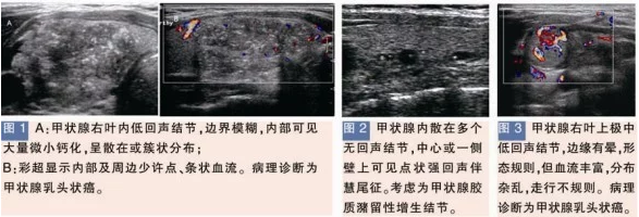 甲状腺良性结节的特征性表现彩超检测图