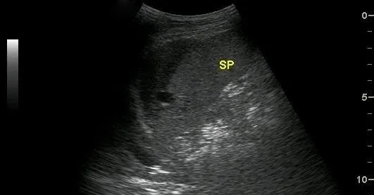 腹部超声创伤性脾破裂的超声诊断